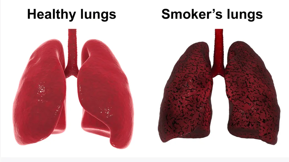 Effects of smoking on lungs